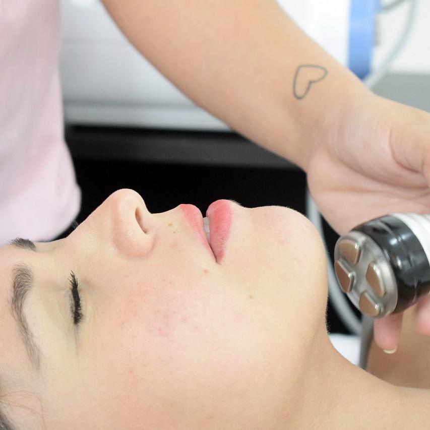 HIFU 22D Última Generación (Papada + Cuello)